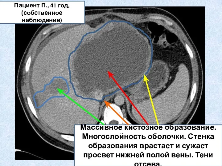 Массивное кистозное образование. Многослойность оболочки. Стенка образования врастает и сужает просвет нижней