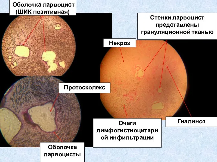 Стенки ларвоцист представлены грануляционной тканью Гиалиноз Некроз Очаги лимфогистиоцитарной инфильтрации Протосколекс Оболочка