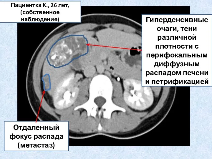 Гиперденсивные очаги, тени различной плотности с перифокальным диффузным распадом печени и петрификацией