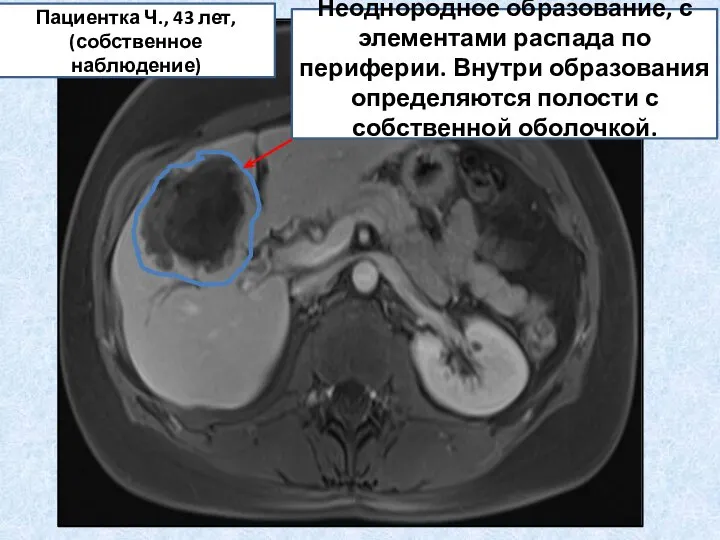 Неоднородное образование, с элементами распада по периферии. Внутри образования определяются полости с