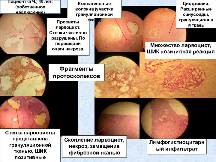 Просветы ларвоцист. Стенки частично разрушены. По периферии очаги некроза. Коллагеновые волокна (участки