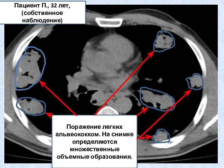 Поражение легких альвеококком. На снимке определяются множественные объемные образования. Пациент П., 32 лет, (собственное наблюдение)