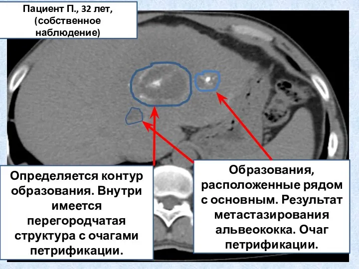 Определяется контур образования. Внутри имеется перегородчатая структура с очагами петрификации. Образования, расположенные