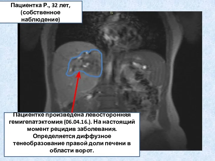 Пациентке произведена левосторонняя гемигепатэктомия (06.04.16.). На настоящий момент рецидив заболевания. Определяется диффузное