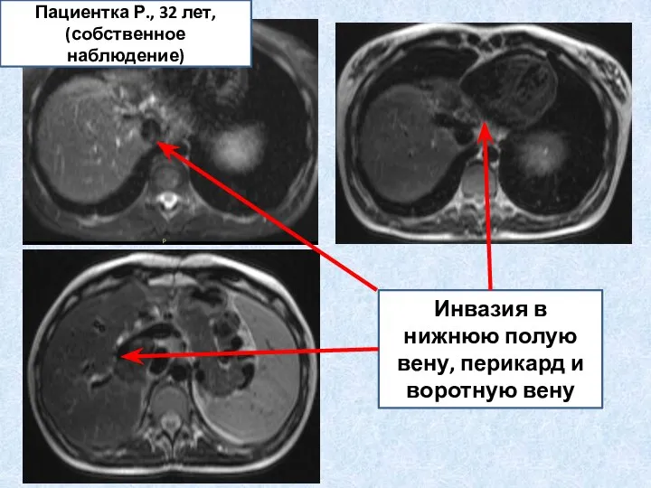 Инвазия в нижнюю полую вену, перикард и воротную вену Пациентка Р., 32 лет, (собственное наблюдение)