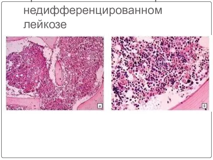 Красный костный мозг при недифференцированном лейкозе