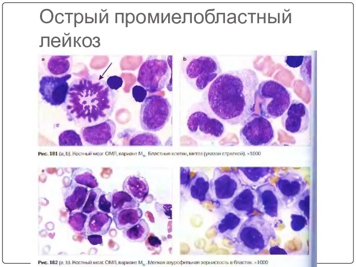 Острый промиелобластный лейкоз