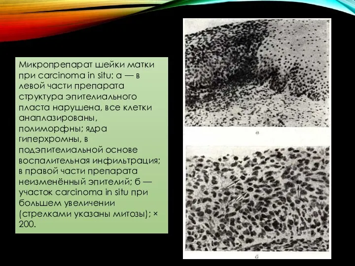 Микропрепарат шейки матки при carcinoma in situ: а — в левой части