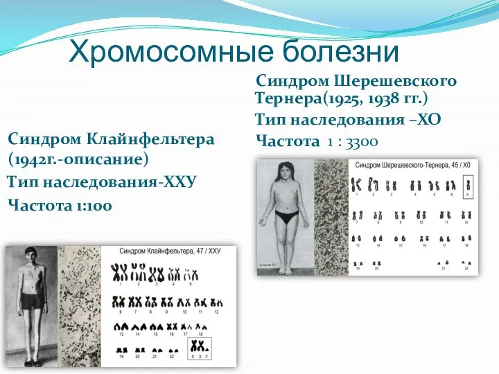 Хромосомные болезни Синдром Клайнфельтера(1942г.-описание) Тип наследования-ХХУ Частота 1:100 Синдром Шерешевского Тернера(1925, 1938
