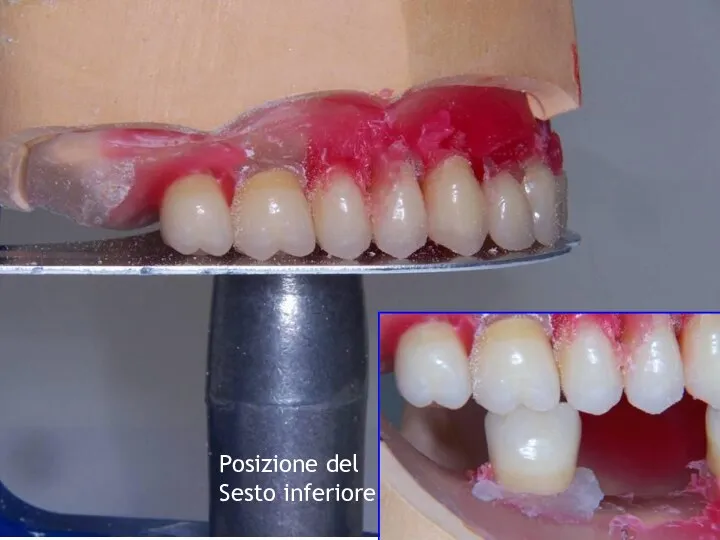 Posizione del Sesto inferiore