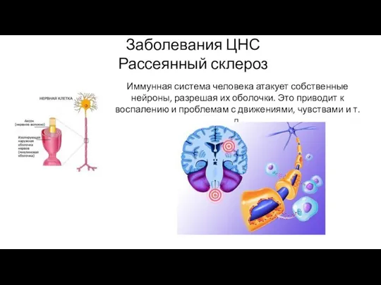 Заболевания ЦНС Рассеянный склероз Иммунная система человека атакует собственные нейроны, разрешая их