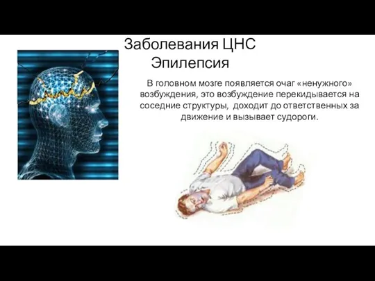 Заболевания ЦНС Эпилепсия В головном мозге появляется очаг «ненужного» возбуждения, это возбуждение