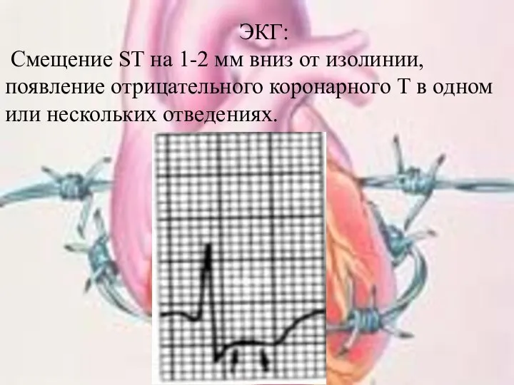 ЭКГ: Смещение ST на 1-2 мм вниз от изолинии, появление отрицательного коронарного