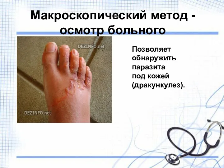 Макроскопический метод - осмотр больного Позволяет обнаружить паразита под кожей (дракункулез).