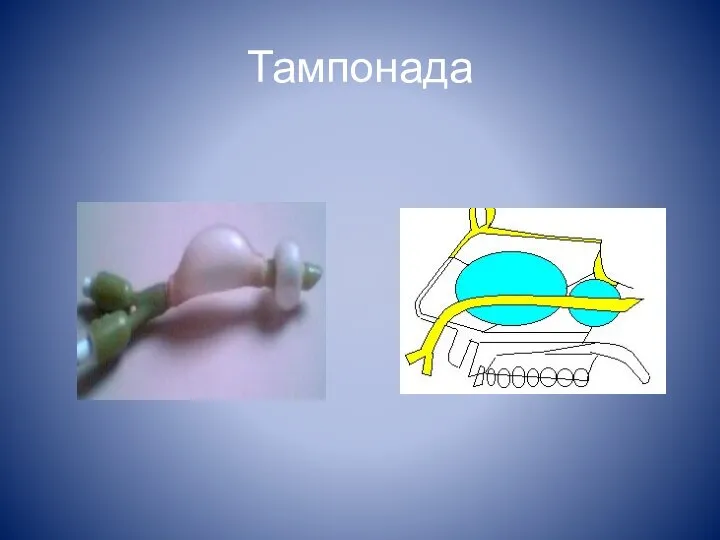 Тампонада