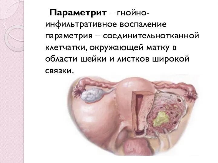 Параметрит – гнойно-инфильтративное воспаление параметрия – соединительнотканной клетчатки, окружающей матку в области