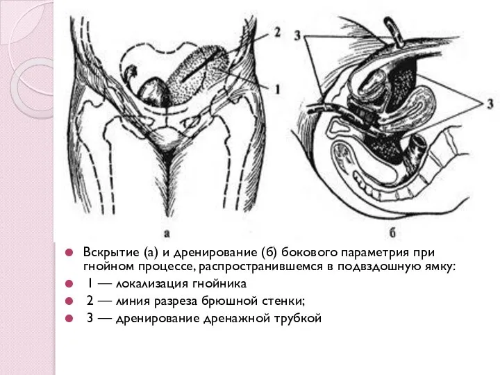 Вскрытие (а) и дренирование (б) бокового параметрия при гнойном процессе, распространившемся в