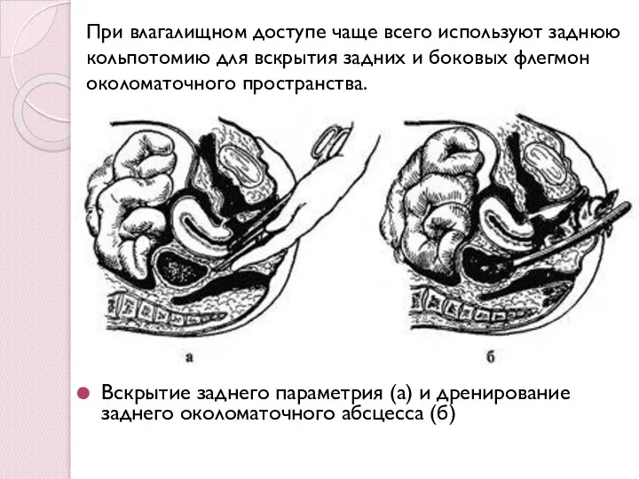 Вскрытие заднего параметрия (а) и дренирование заднего околоматочного абсцесса (б) При влагалищном