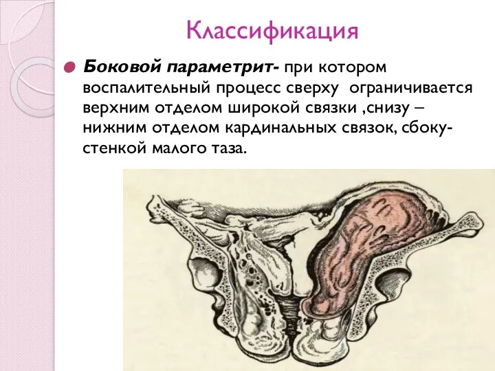 Классификация Боковой параметрит- при котором воспалительный процесс сверху ограничивается верхним отделом широкой