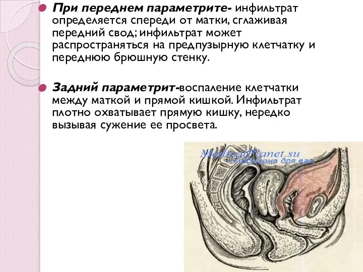 При переднем параметрите- инфильтрат определяется спереди от матки, сглаживая передний свод; инфильтрат