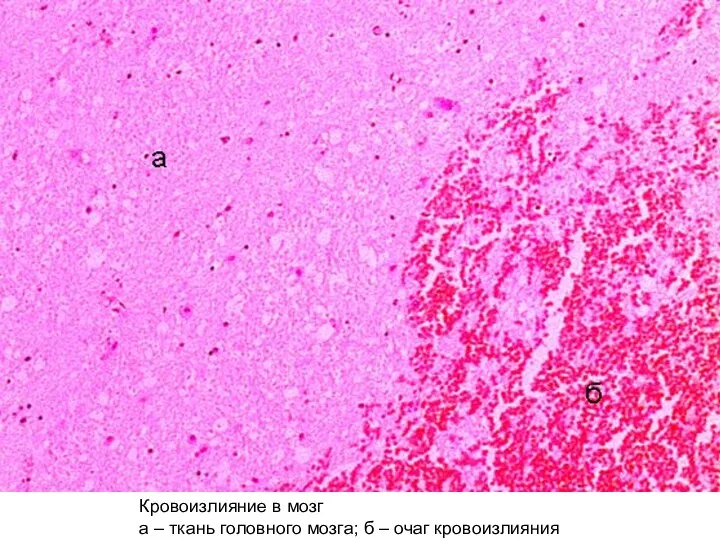 Кровоизлияние в мозг а – ткань головного мозга; б – очаг кровоизлияния