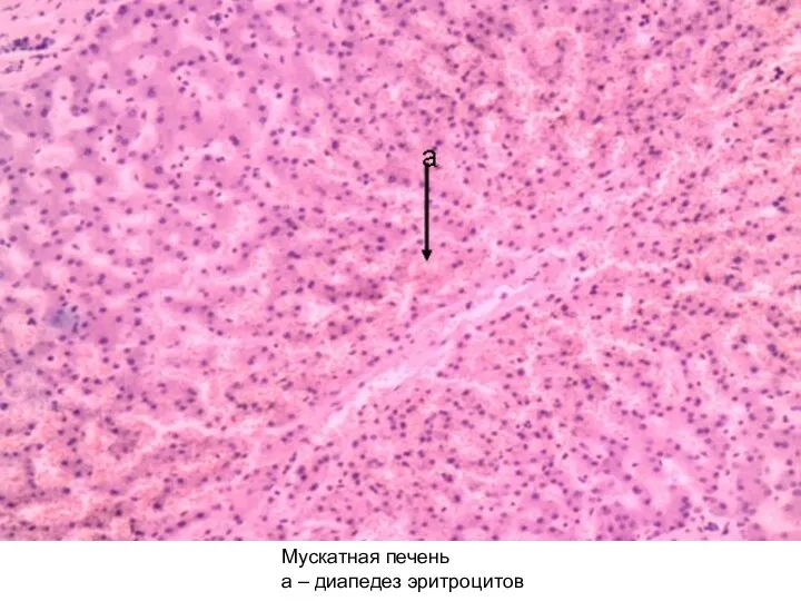 Мускатная печень а – диапедез эритроцитов
