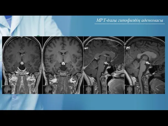 МРТ-дағы гипофиздің аденомасы