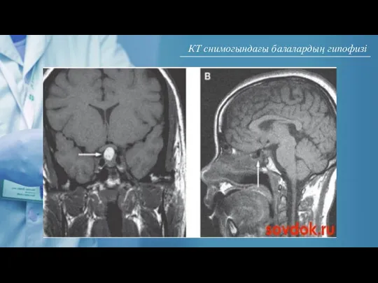 КТ снимогындағы балалардың гипофизі