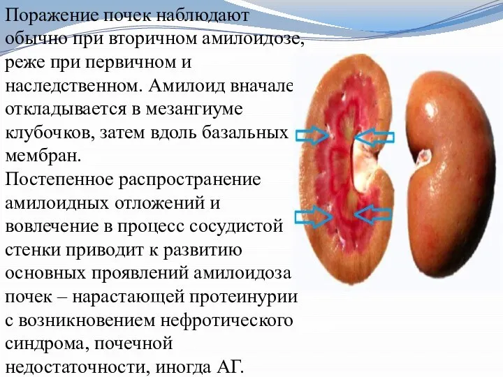 Поражение почек наблюдают обычно при вторичном амилоидозе, реже при первичном и наследственном.