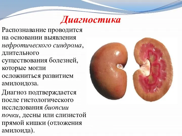 Диагностика Распознавание проводится на основании выявления нефротического синдрома, длительного существования болезней, которые