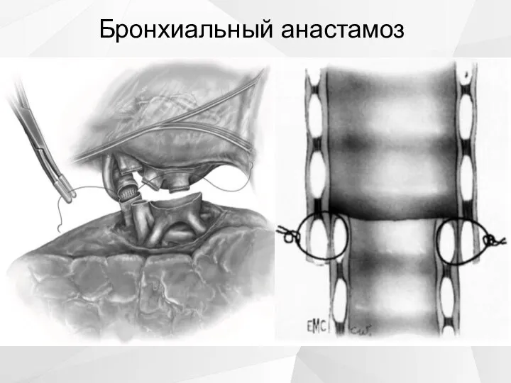 Бронхиальный анастамоз