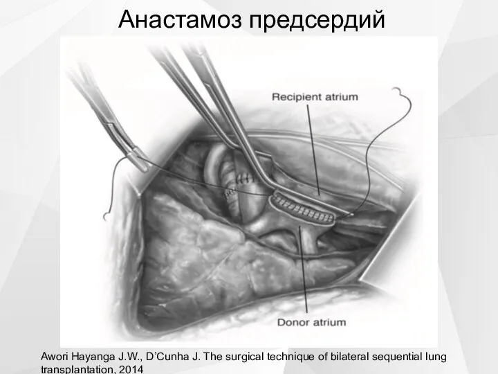 Анастамоз предсердий Awori Hayanga J.W., D’Cunha J. The surgical technique of bilateral sequential lung transplantation, 2014