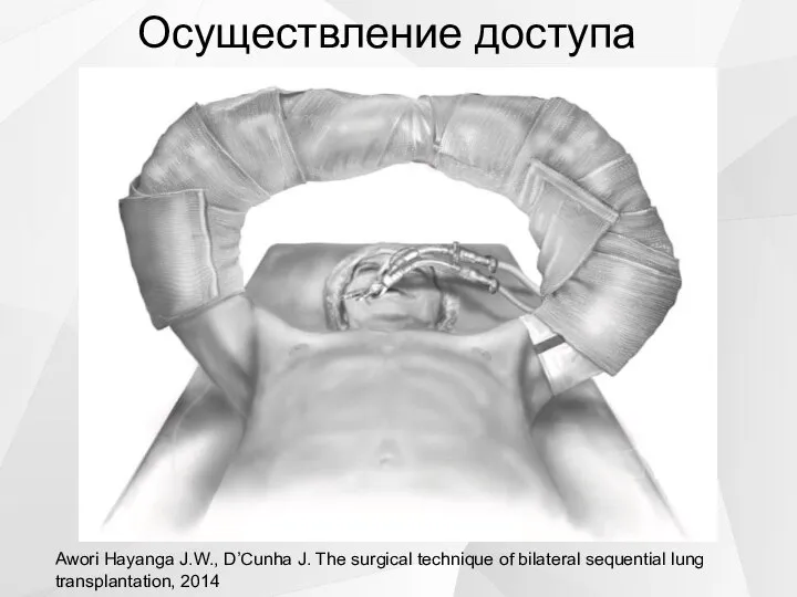 Осуществление доступа Awori Hayanga J.W., D’Cunha J. The surgical technique of bilateral sequential lung transplantation, 2014