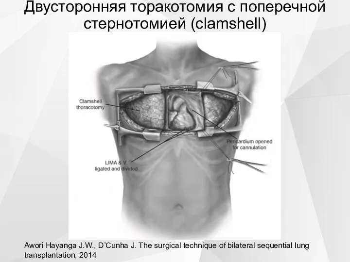 Двусторонняя торакотомия с поперечной стернотомией (clamshell) Awori Hayanga J.W., D’Cunha J. The