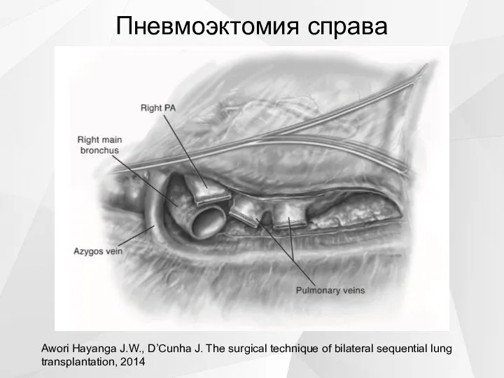 Пневмоэктомия справа Awori Hayanga J.W., D’Cunha J. The surgical technique of bilateral sequential lung transplantation, 2014