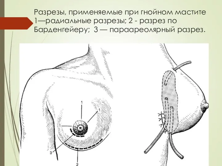 Разрезы, применяемые при гнойном мастите 1—радиальные разрезы; 2 - разрез по Барденгейеру; 3 — параареолярный разрез.