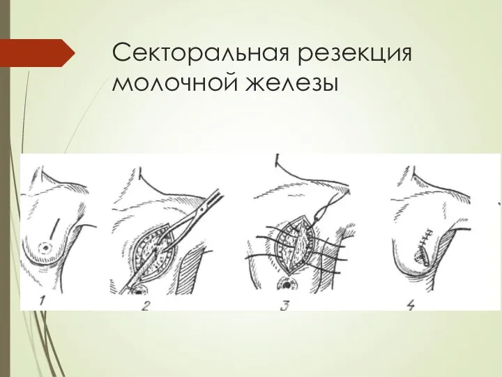 Секторальная резекция молочной железы