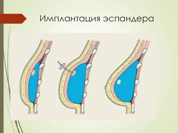 Имплантация эспандера