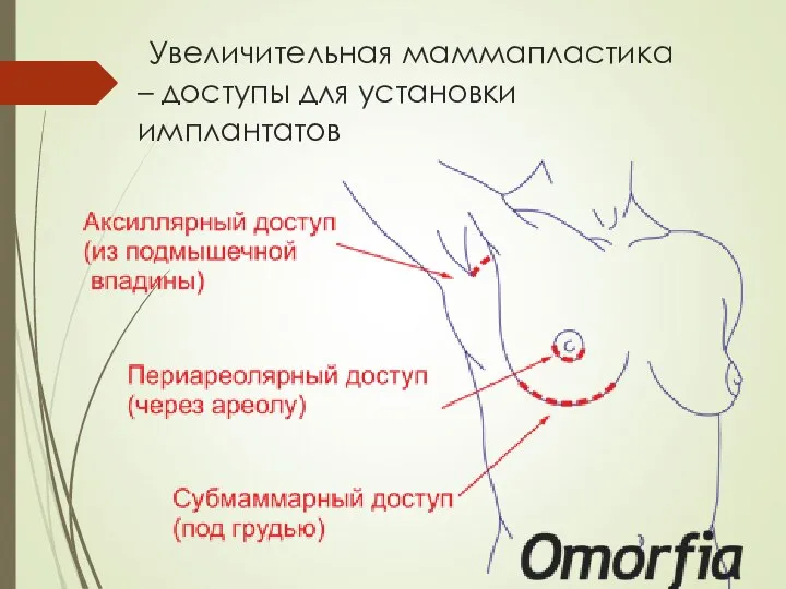 Увеличительная маммапластика – доступы для установки имплантатов