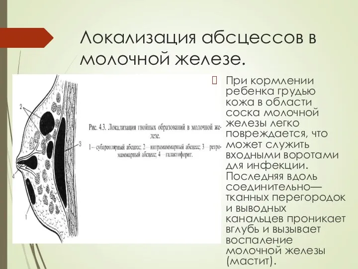 Локализация абсцессов в молочной железе. При кормлении ребенка грудью кожа в области