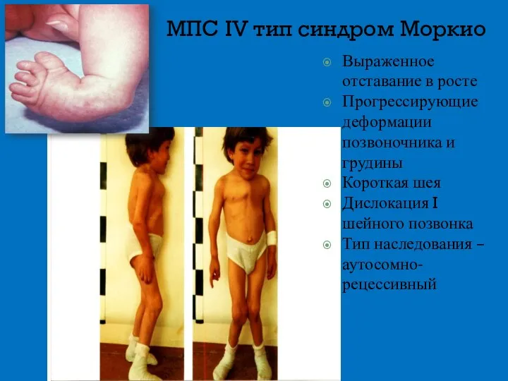 МПС IV тип синдром Моркио Выраженное отставание в росте Прогрессирующие деформации позвоночника