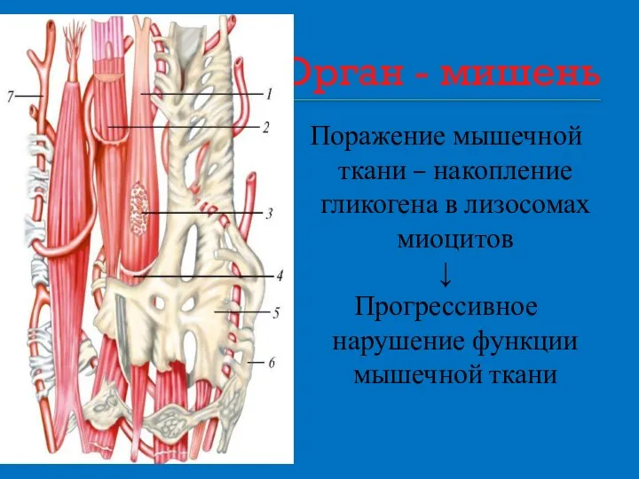 Орган - мишень Поражение мышечной ткани – накопление гликогена в лизосомах миоцитов