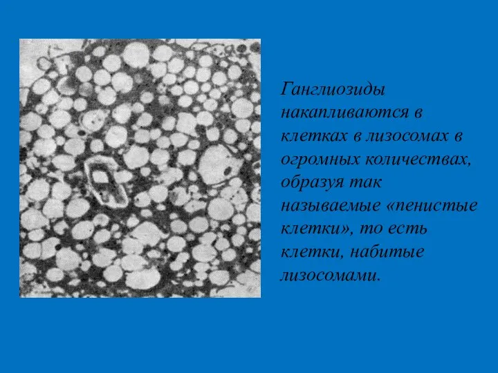 Ганглиозиды накапливаются в клетках в лизосомах в огромных количествах, образуя так называемые