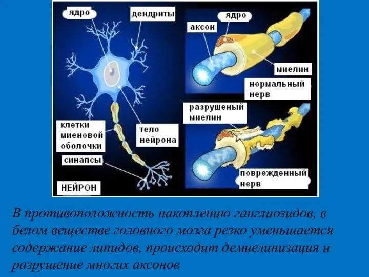 В противоположность накоплению ганглиозидов, в белом веществе головного мозга резко уменьшается содержание