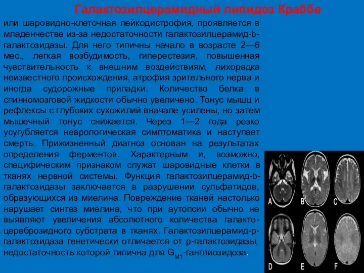 Галактозилцерамидный липидоз Краббе или шаровидно-клеточная лейкодистрофия, проявляется в младенчестве из-за недостаточности галактозилцерамид-b-галактозидазы.