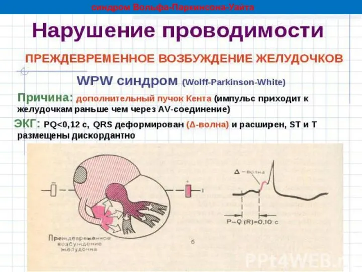 синдром Вольфа-Паркинсона-Уайта