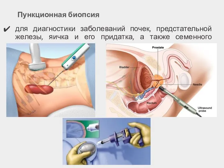 Пункционная биопсия для диагностики заболеваний почек, предстательной железы, яичка и его придатка, а также семенного пузырька