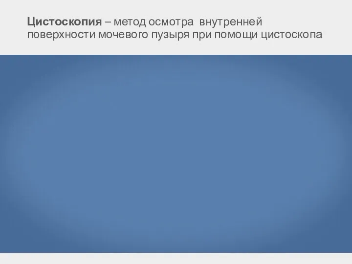 Цистоскопия – метод осмотра внутренней поверхности мочевого пузыря при помощи цистоскопа