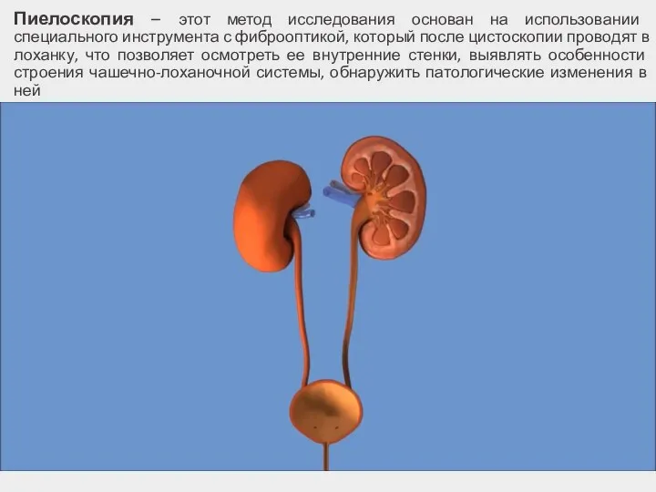 Пиелоскопия – этот метод исследования основан на использовании специального инструмента с фиброоптикой,