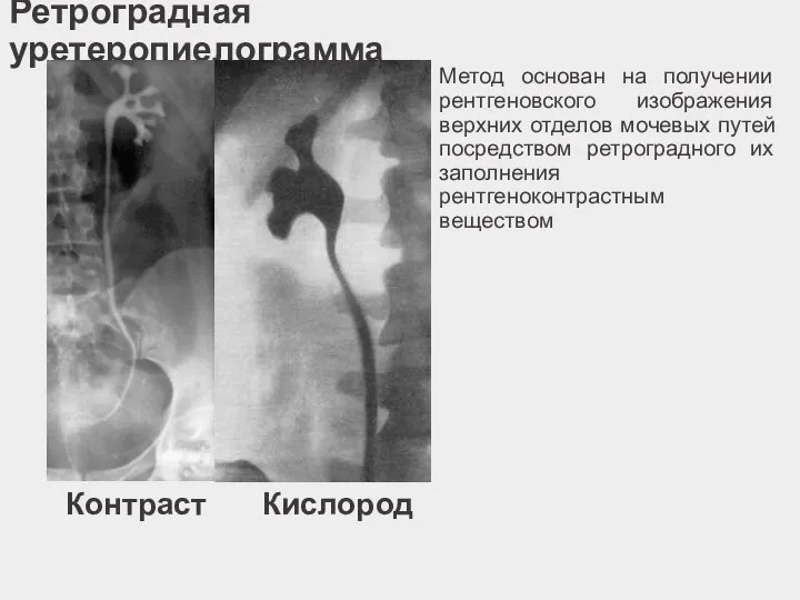 Ретроградная уретеропиелограмма Метод основан на получении рентгеновского изображения верхних отделов мочевых путей